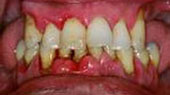 Caso Periodontitis